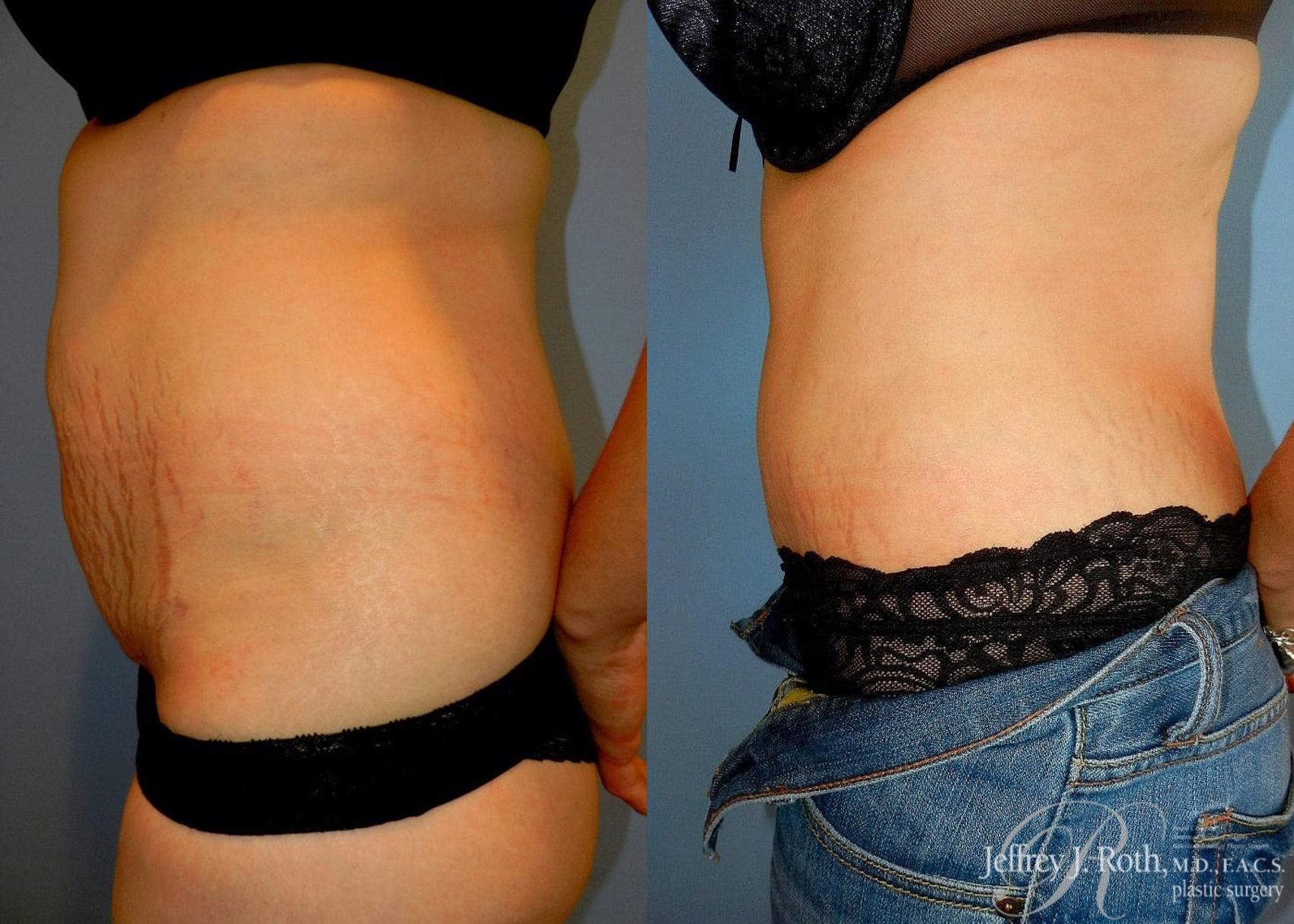 Before & After Tummy Tuck Case 24 View #3 View in Las Vegas, NV