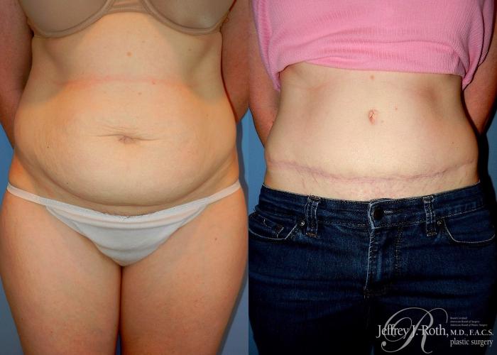 Before & After Tummy Tuck Case 25 View #1 View in Las Vegas and Henderson, NV