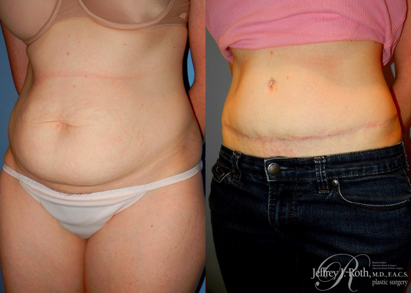 Before & After Tummy Tuck Case 25 View #2 View in Las Vegas, NV