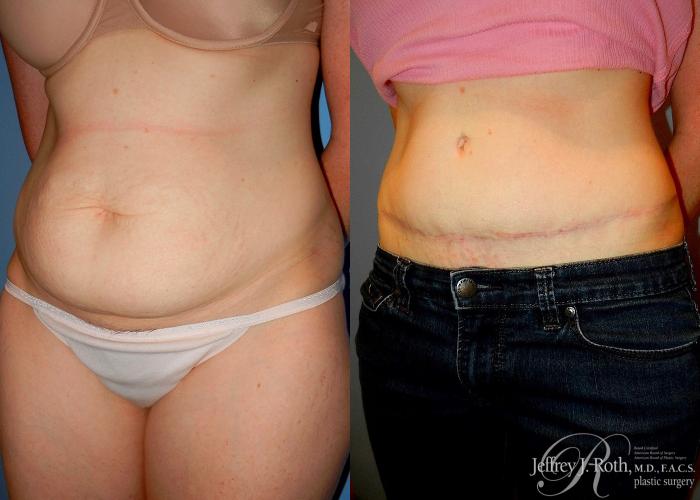 Before & After Tummy Tuck Case 25 View #2 View in Las Vegas and Henderson, NV