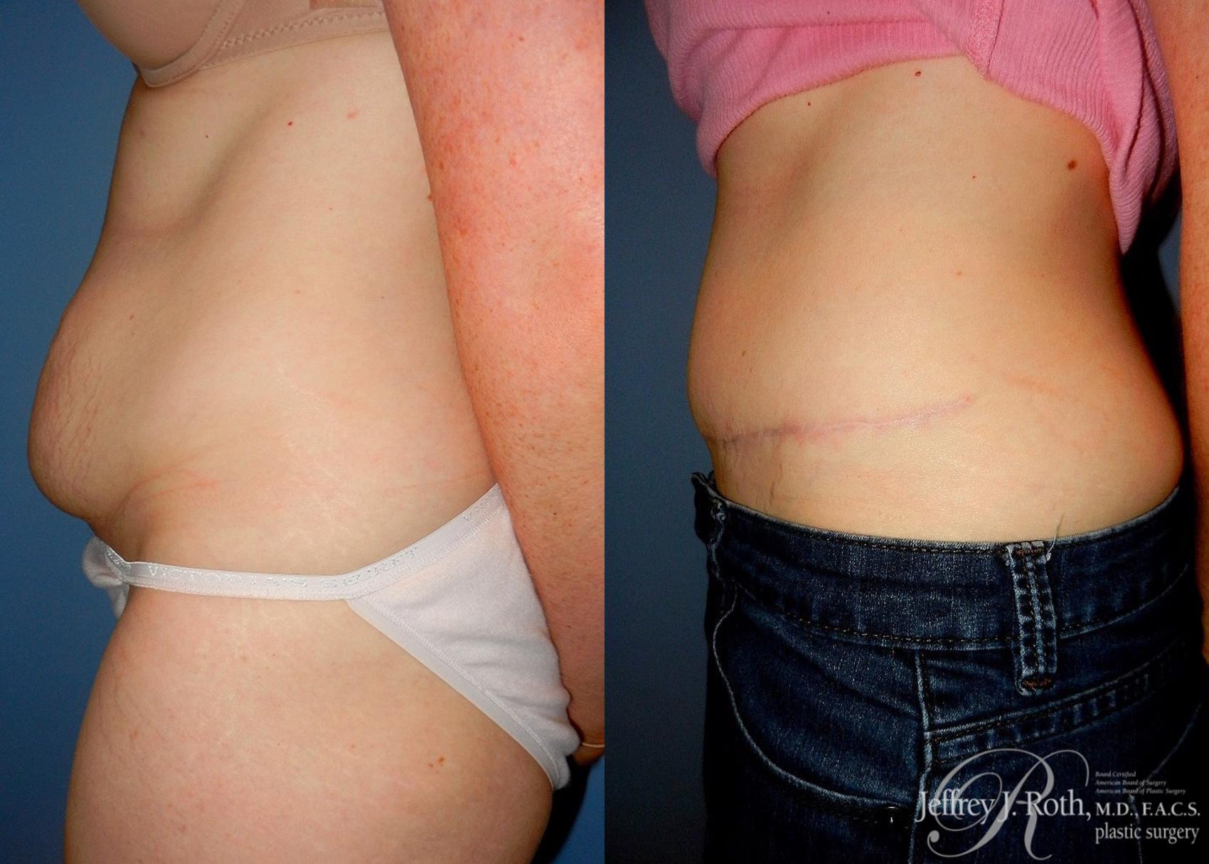 Before & After Tummy Tuck Case 25 View #3 View in Las Vegas, NV