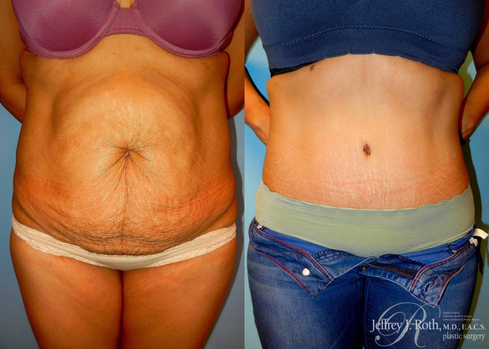 Before & After Tummy Tuck Case 26 View #1 View in Las Vegas, NV