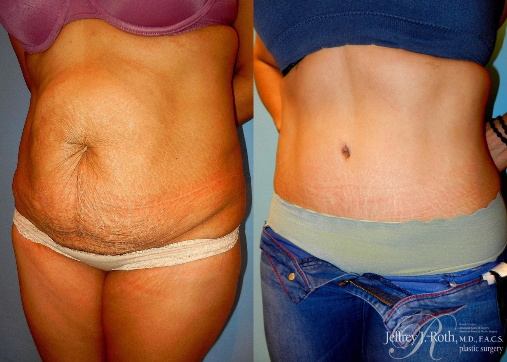 Before & After Tummy Tuck Case 26 View #2 View in Las Vegas, NV