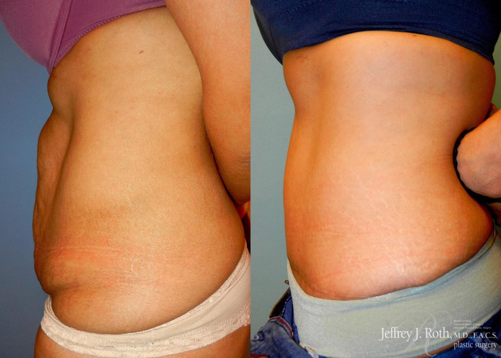 Before & After Tummy Tuck Case 26 View #3 View in Las Vegas, NV