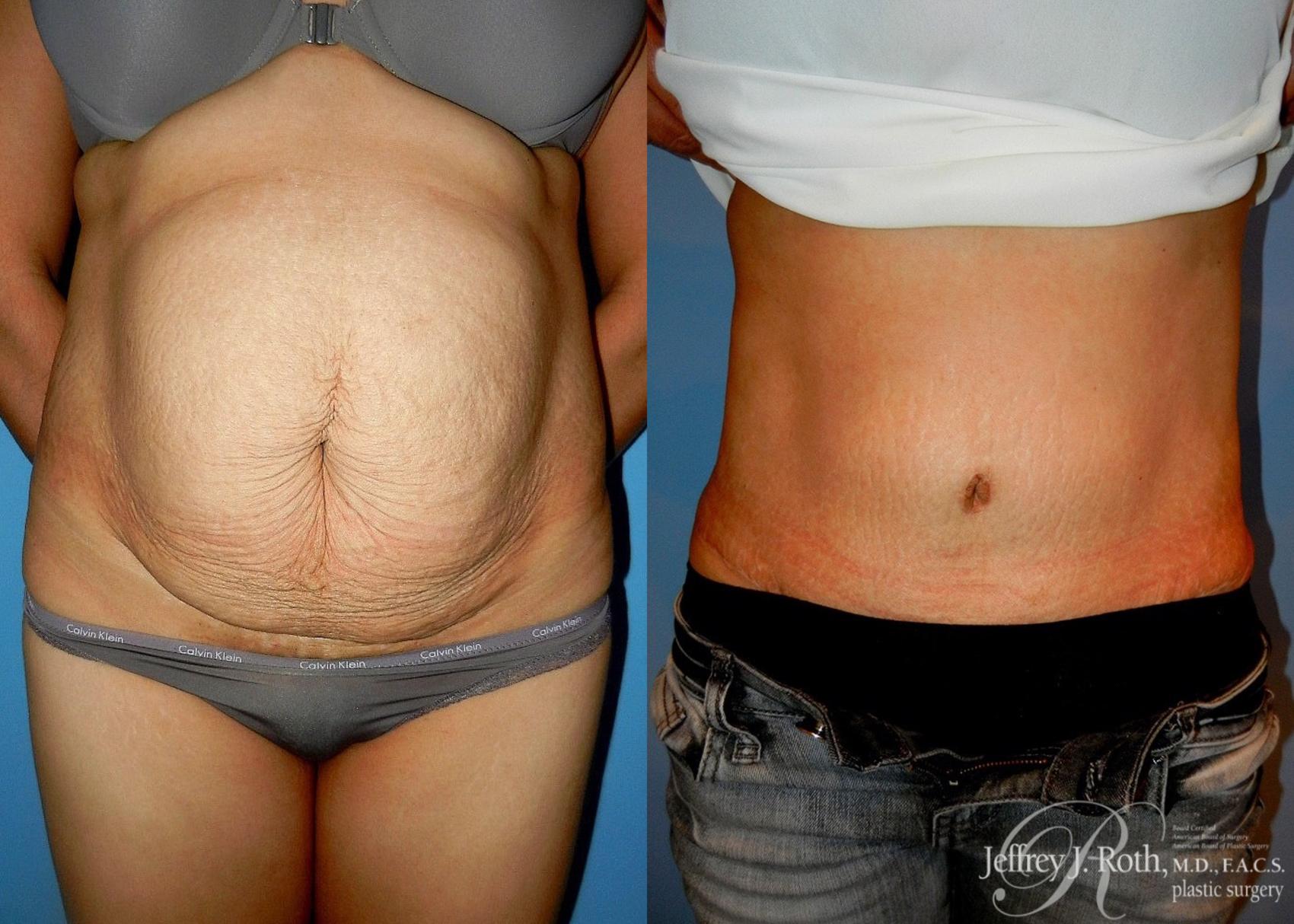 Before & After Tummy Tuck Case 27 View #1 View in Las Vegas and Henderson, NV