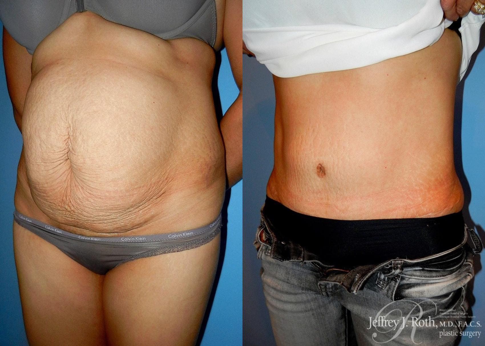 Before & After Tummy Tuck Case 27 View #2 View in Las Vegas, NV