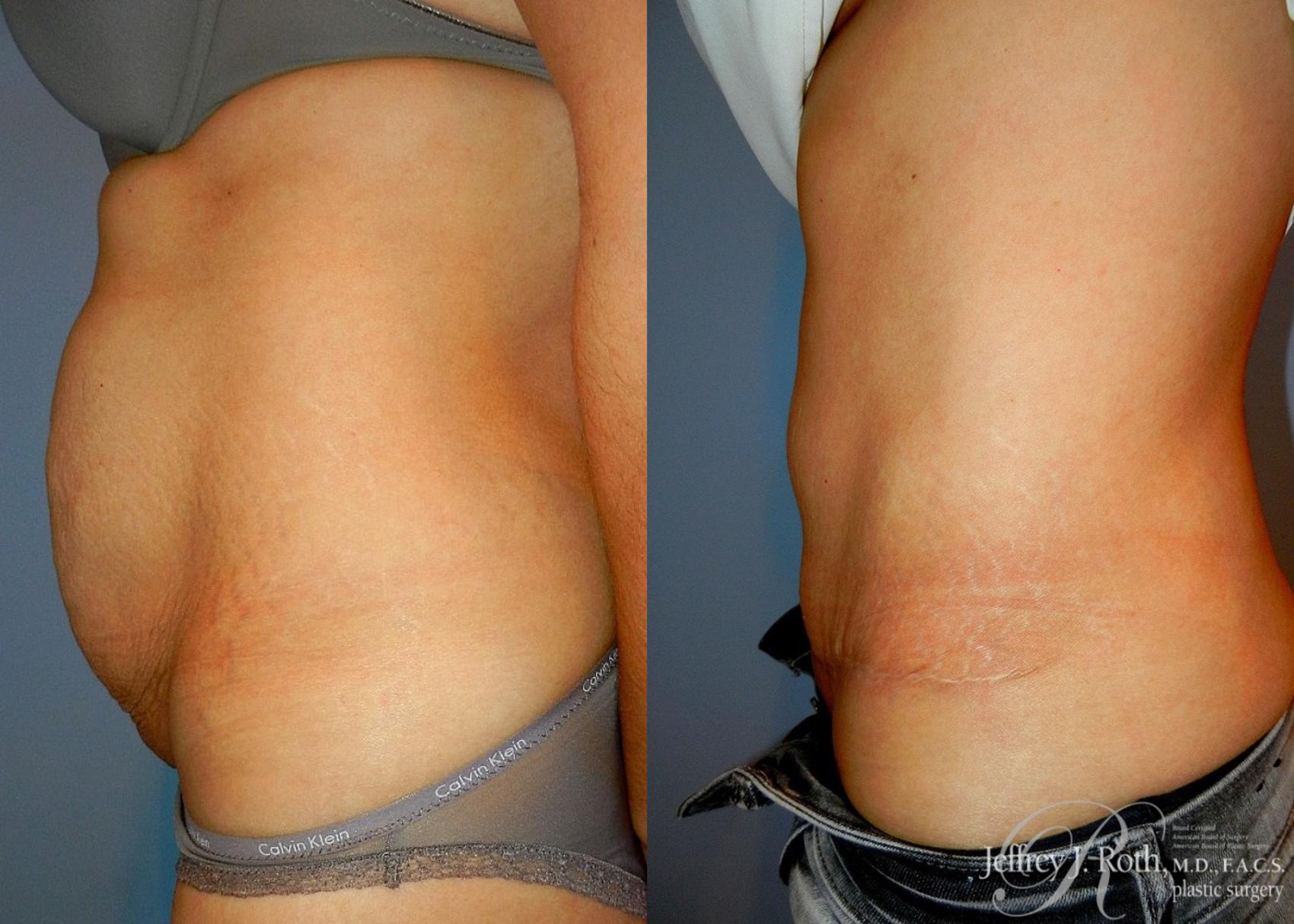 Before & After Tummy Tuck Case 27 View #3 View in Las Vegas, NV