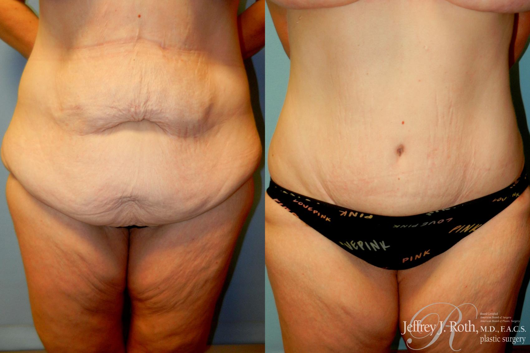 Before & After Tummy Tuck Case 274 Front View in Las Vegas and Henderson, NV