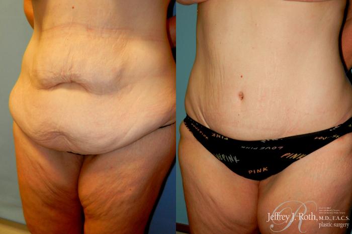 Before & After Tummy Tuck Case 274 Left Oblique View in Las Vegas and Henderson, NV