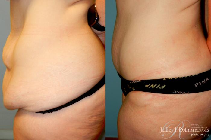 Before & After Tummy Tuck Case 274 Left Side View in Las Vegas and Henderson, NV