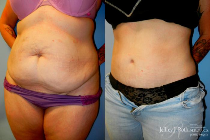 Before & After Tummy Tuck Case 279 Left Oblique View in Las Vegas and Henderson, NV