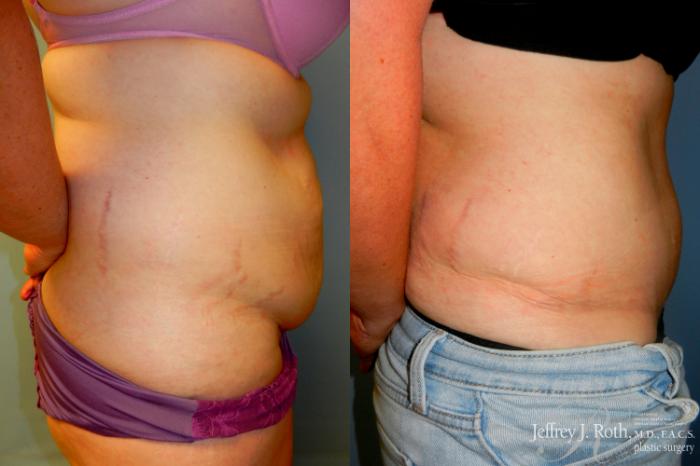Before & After Tummy Tuck Case 279 Right Side View in Las Vegas and Henderson, NV