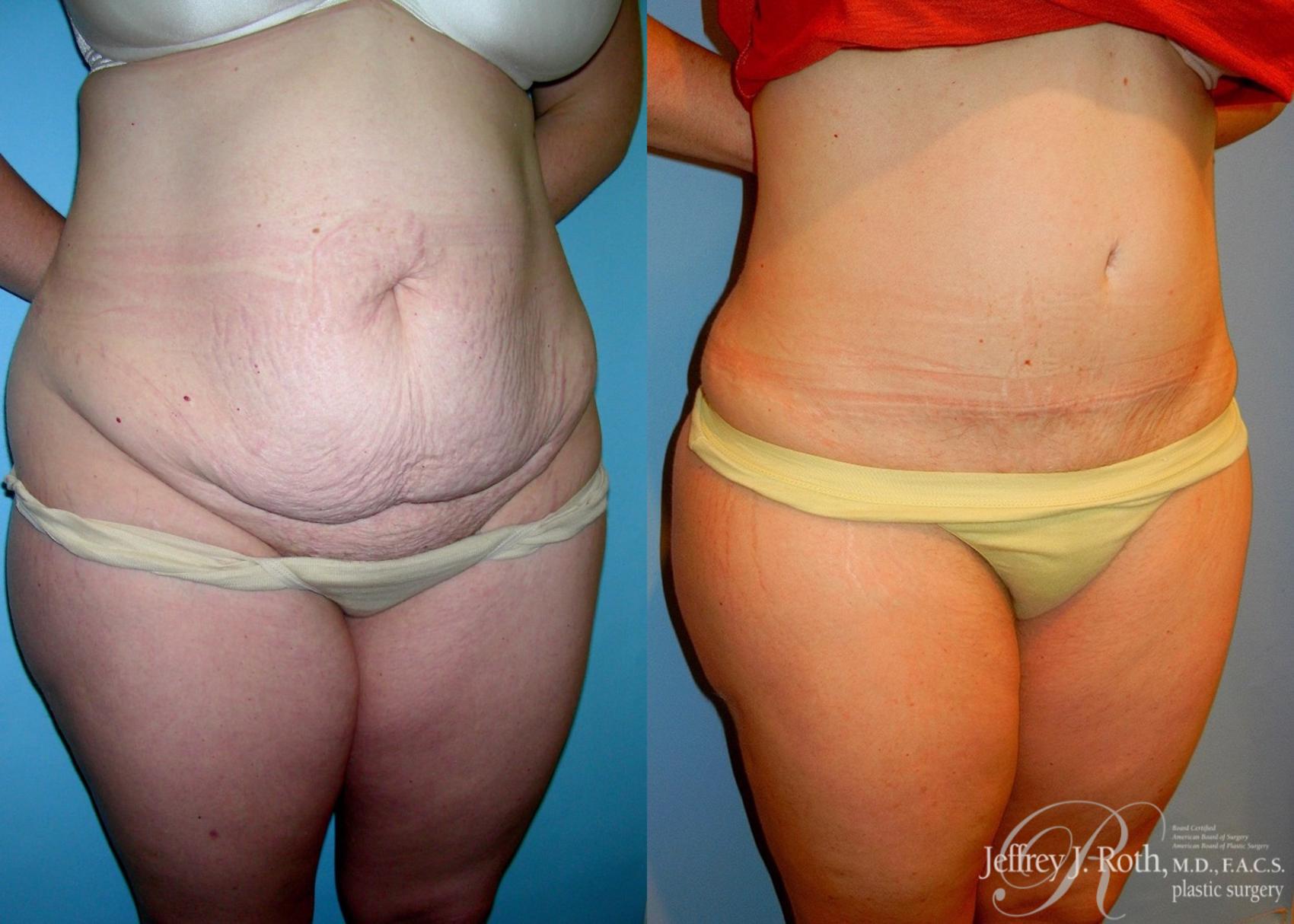 Before & After Tummy Tuck Case 28 View #2 View in Las Vegas, NV