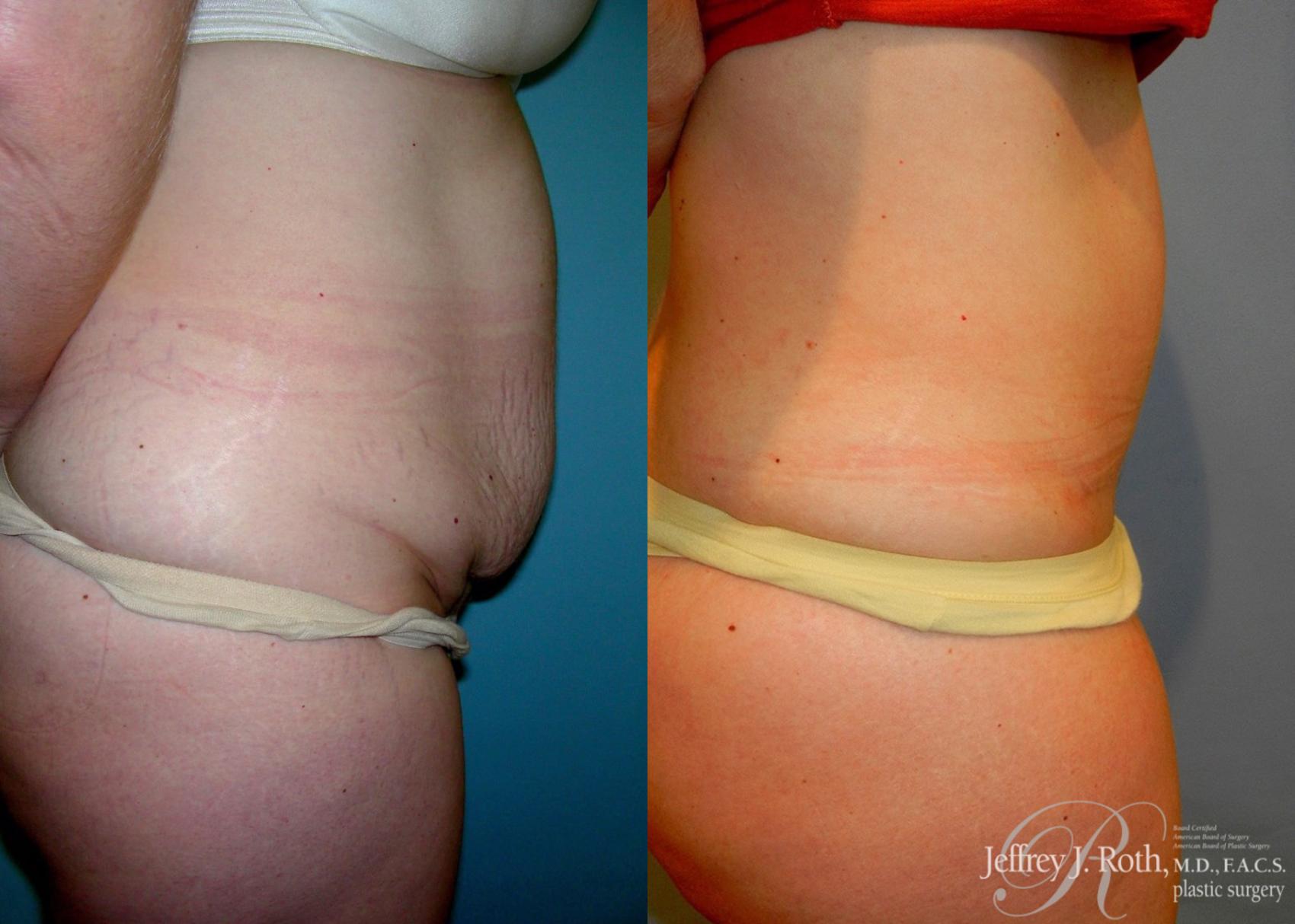 Before & After Tummy Tuck Case 28 View #3 View in Las Vegas, NV