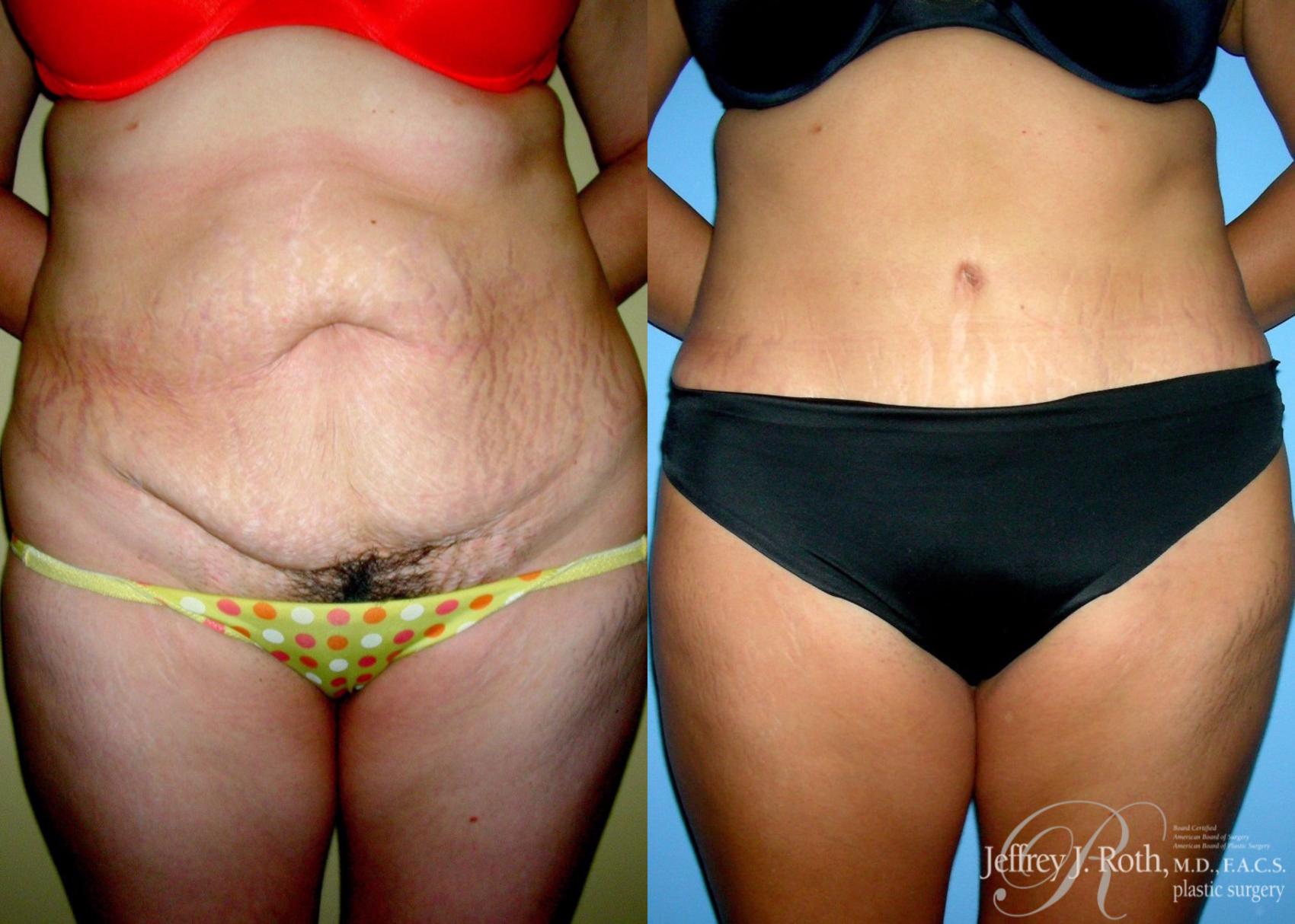 Before & After Tummy Tuck Case 29 View #1 View in Las Vegas, NV