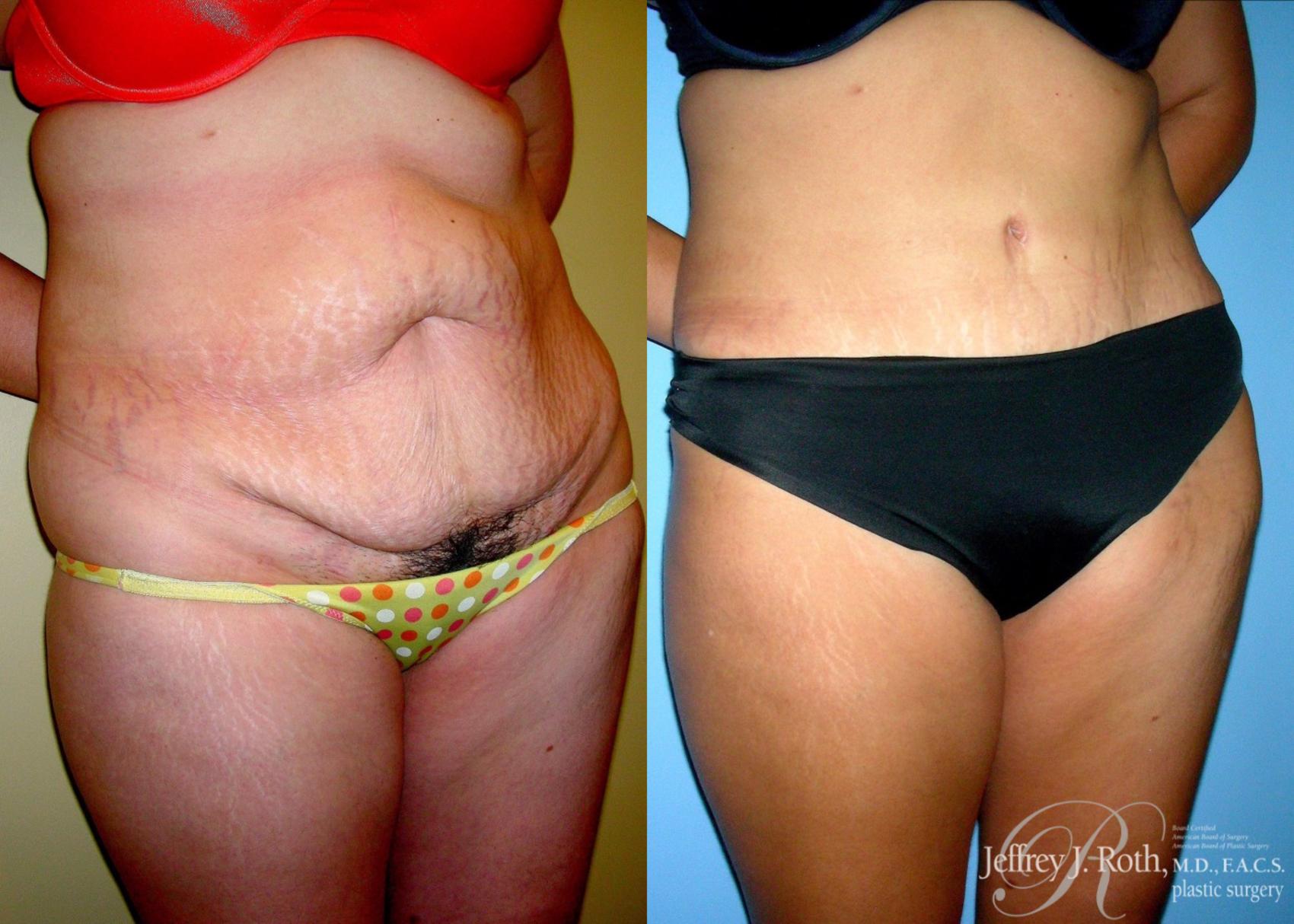 Before & After Tummy Tuck Case 29 View #2 View in Las Vegas, NV