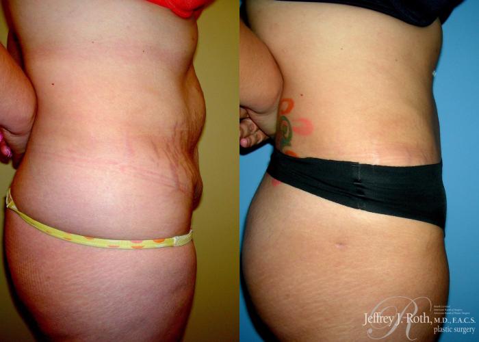 Before & After Tummy Tuck Case 29 View #3 View in Las Vegas and Henderson, NV