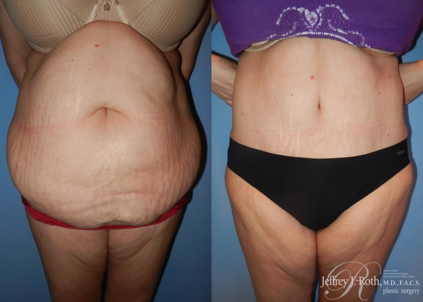 Before & After Tummy Tuck Case 30 View #1 View in Las Vegas, NV