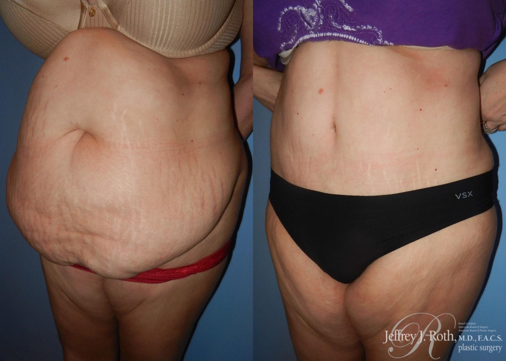 Before & After Tummy Tuck Case 30 View #2 View in Las Vegas, NV