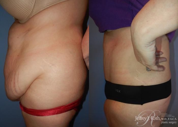 Before & After Tummy Tuck Case 30 View #3 View in Las Vegas and Henderson, NV