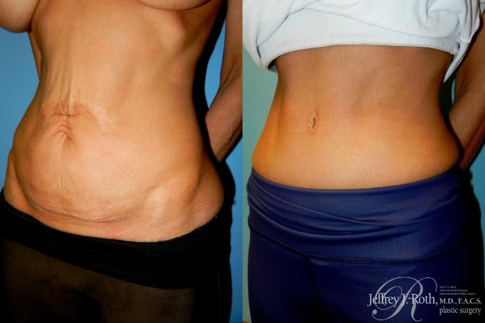 Before & After Tummy Tuck Case 309 Left Oblique View in Las Vegas and Henderson, NV