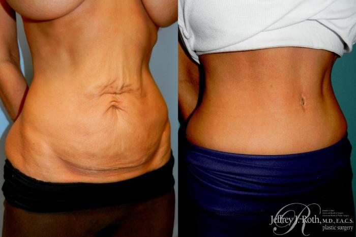 Before & After Tummy Tuck Case 309 Right Oblique View in Las Vegas and Henderson, NV