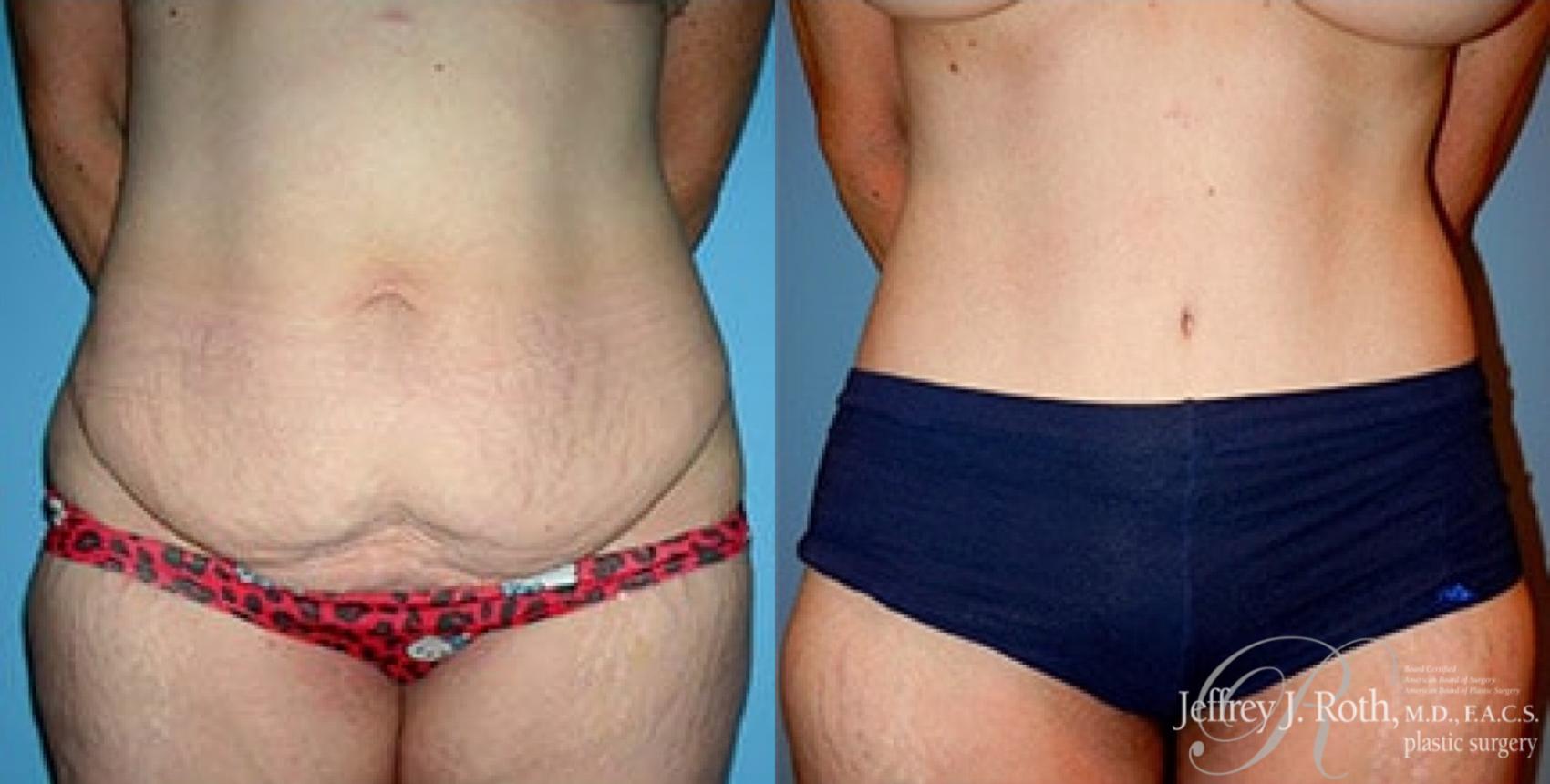 Before & After Tummy Tuck Case 31 View #1 View in Las Vegas, NV
