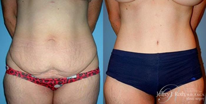 Before & After Tummy Tuck Case 31 View #1 View in Las Vegas and Henderson, NV