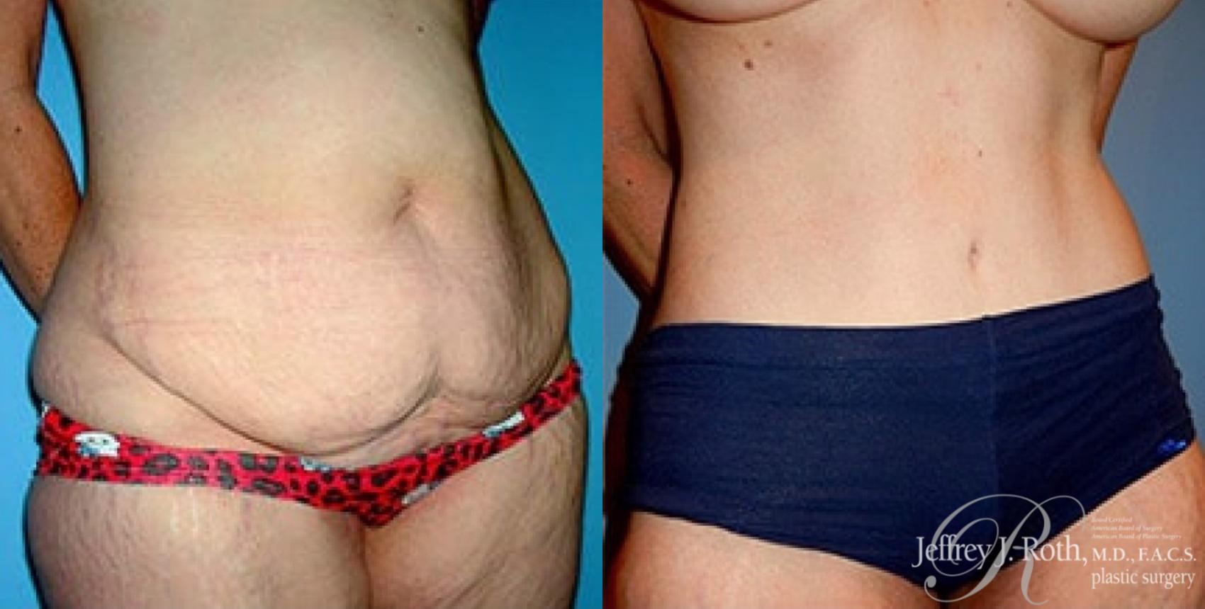 Before & After Tummy Tuck Case 31 View #2 View in Las Vegas, NV