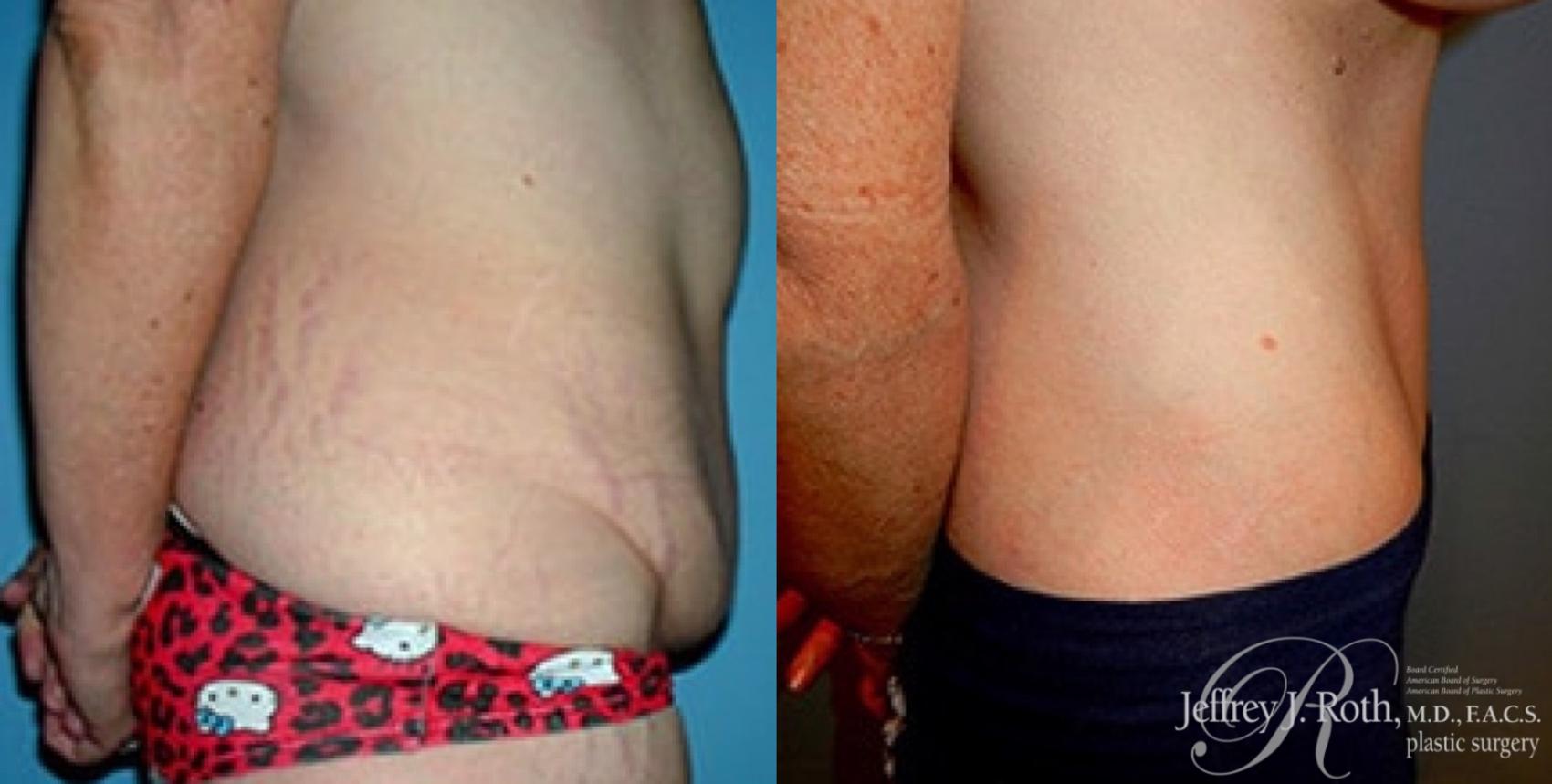 Before & After Tummy Tuck Case 31 View #3 View in Las Vegas, NV