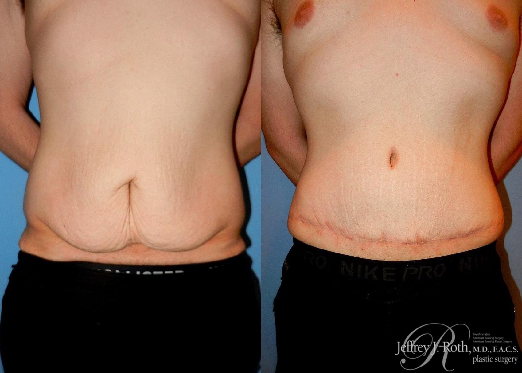 Before & After Tummy Tuck Case 32 View #1 View in Las Vegas, NV
