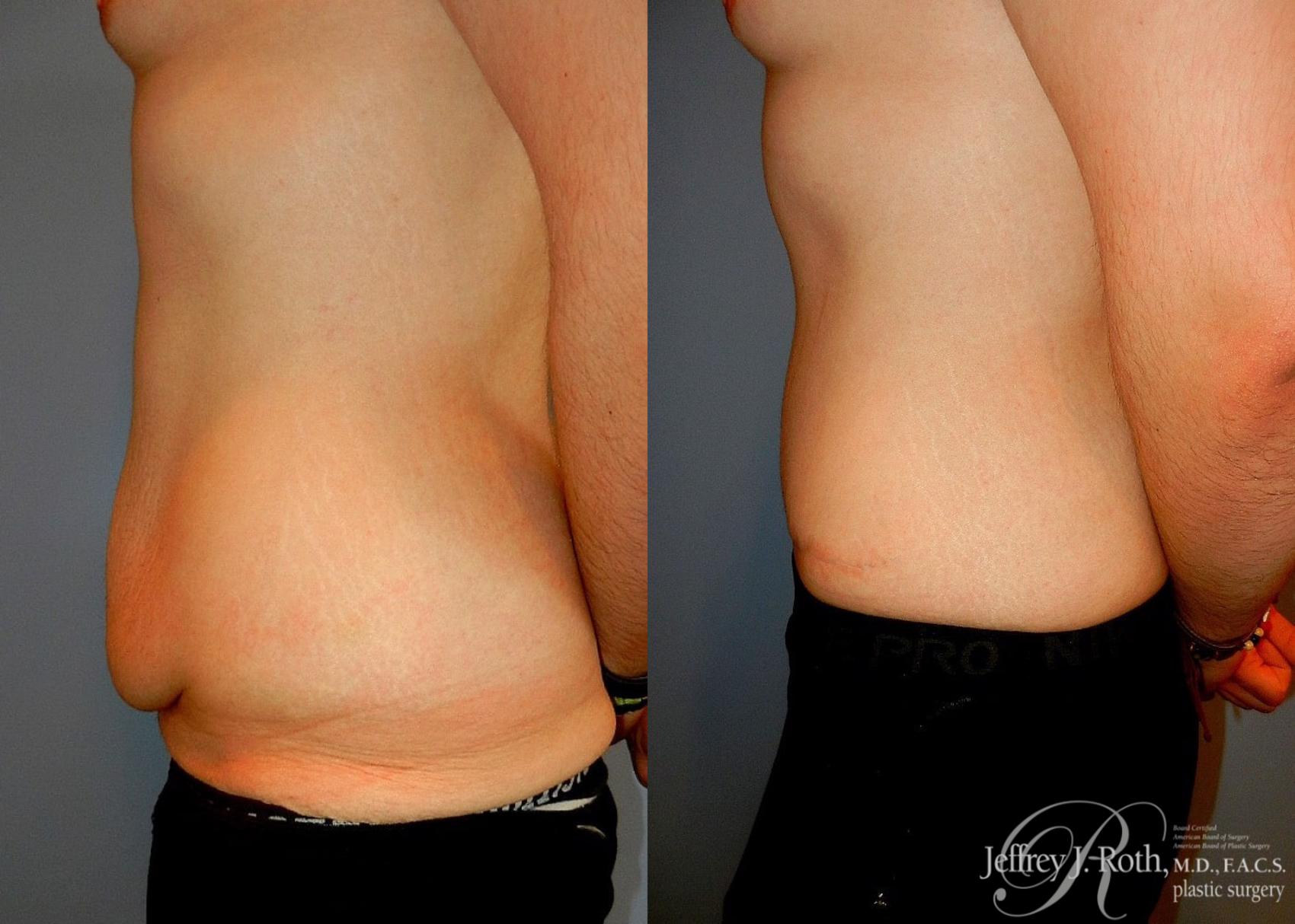 Before & After Tummy Tuck Case 32 View #3 View in Las Vegas, NV