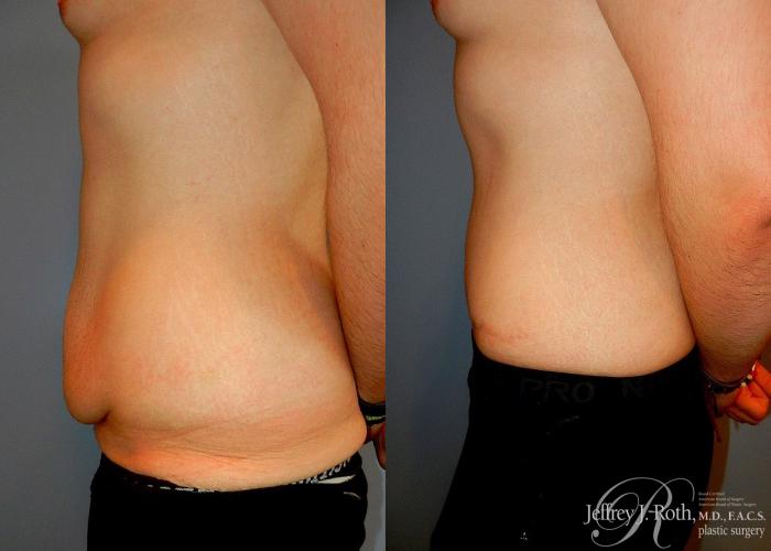 Before & After Tummy Tuck Case 32 View #3 View in Las Vegas, NV