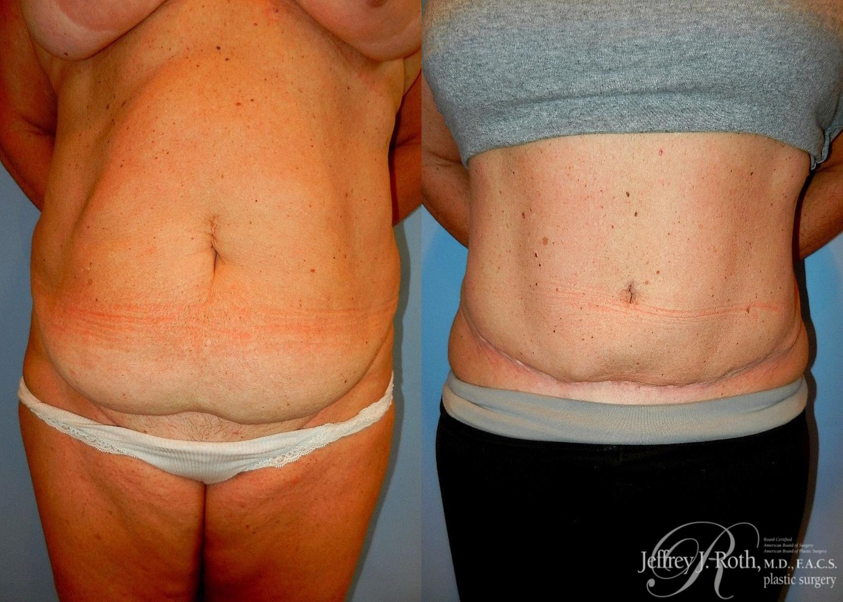 Before & After Tummy Tuck Case 33 View #1 View in Las Vegas, NV