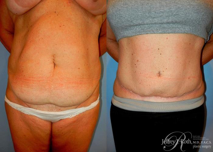 Before & After Tummy Tuck Case 33 View #1 View in Las Vegas and Henderson, NV