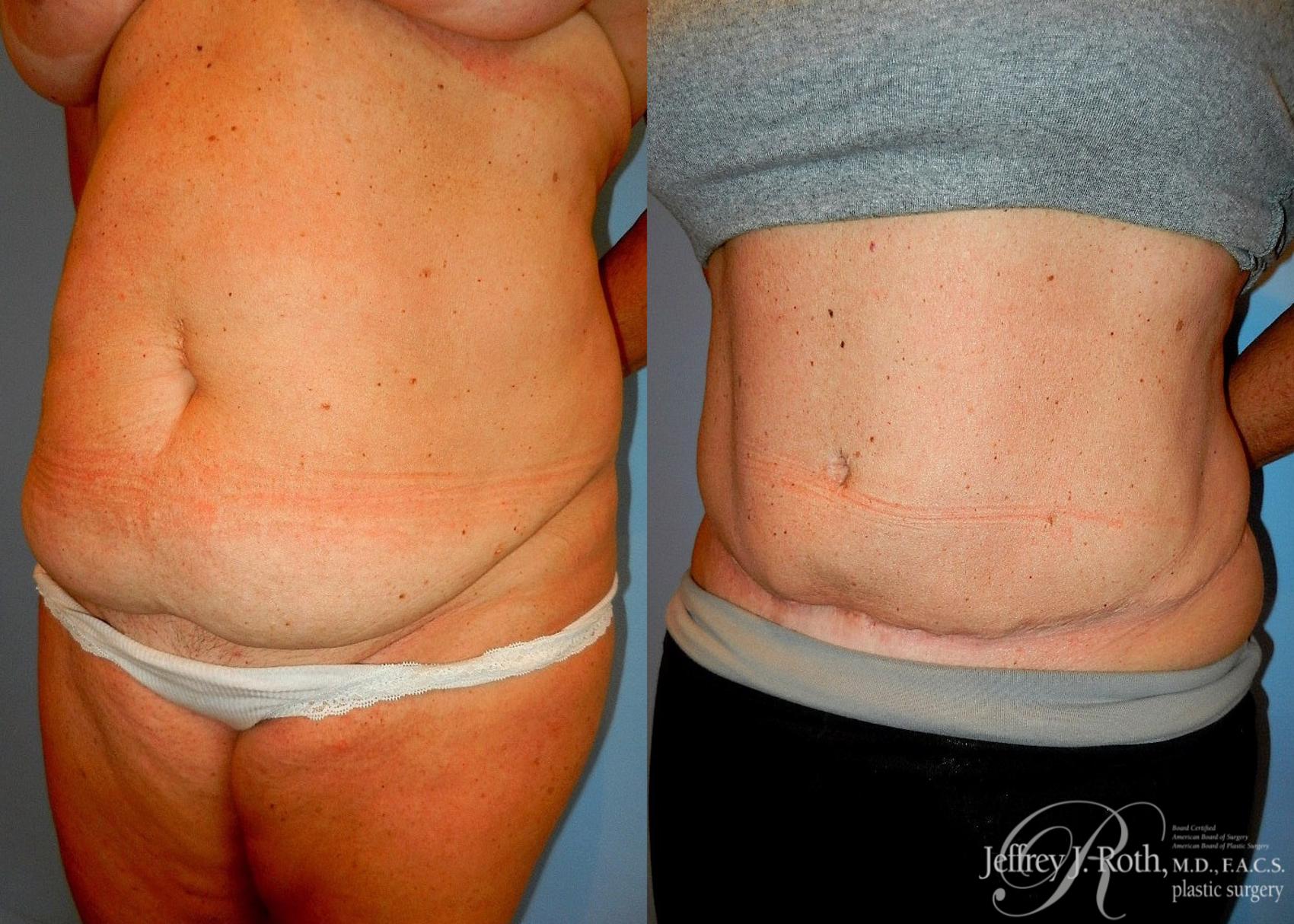 Before & After Tummy Tuck Case 33 View #2 View in Las Vegas, NV