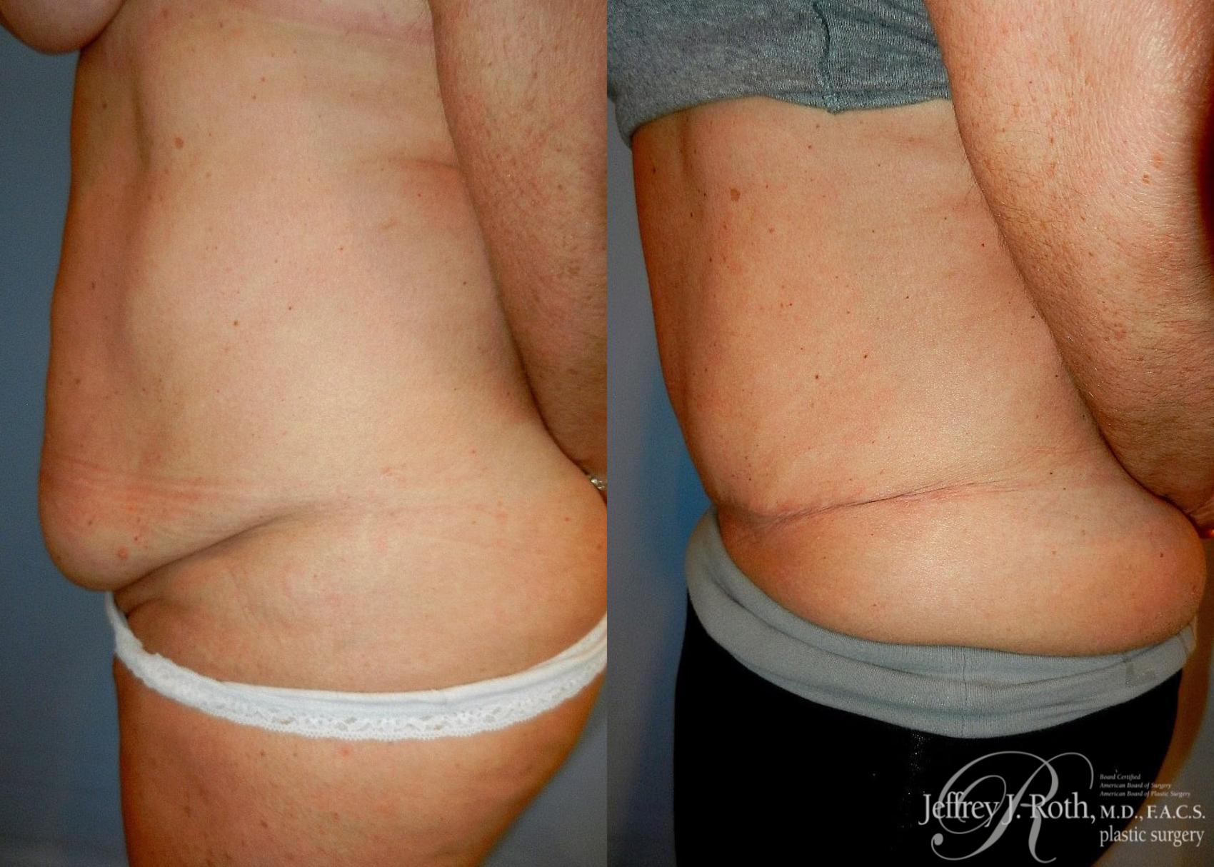 Before & After Tummy Tuck Case 33 View #3 View in Las Vegas, NV