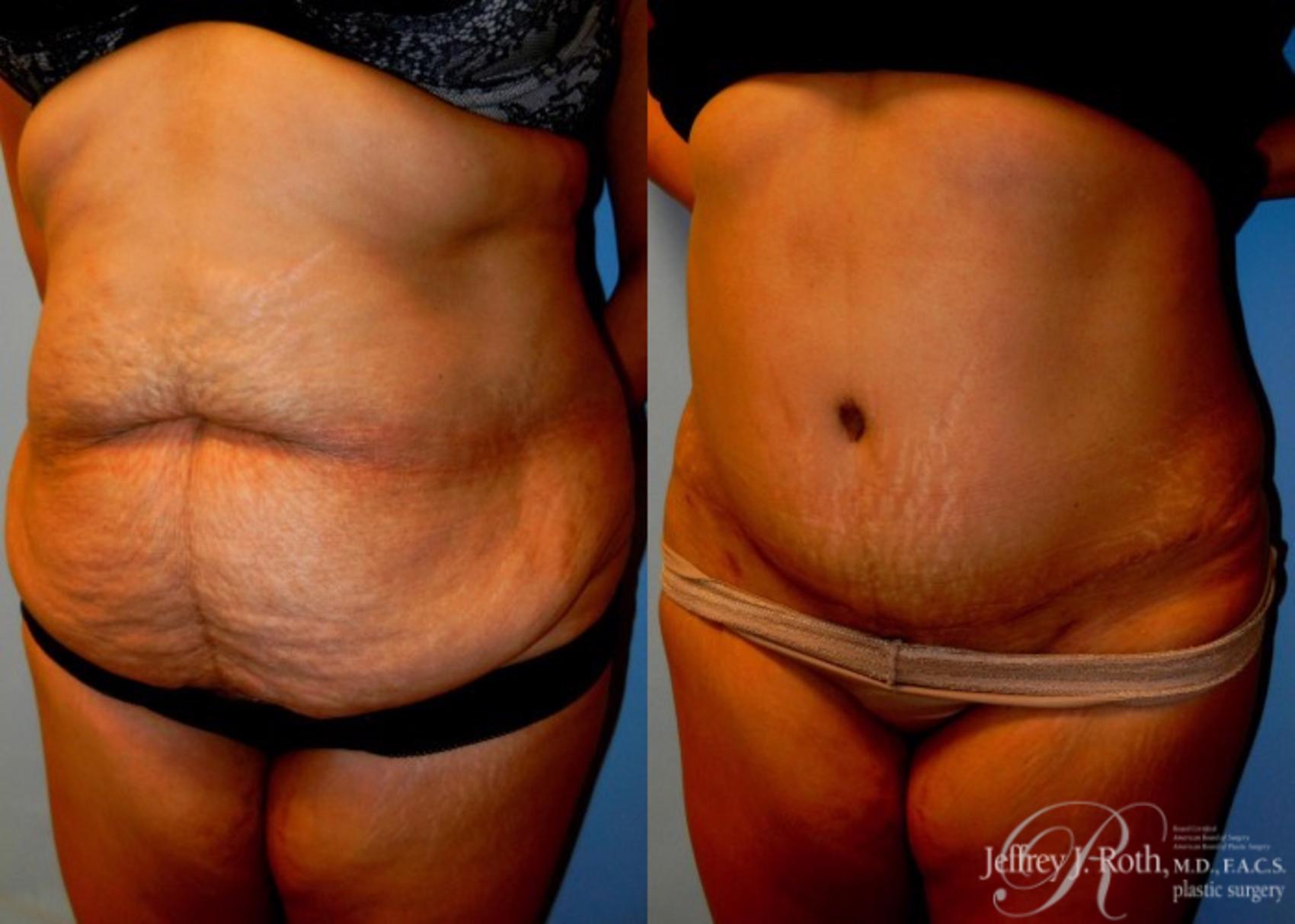 Before & After Tummy Tuck Case 34 View #2 View in Las Vegas, NV