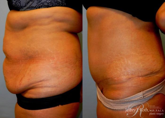 Before & After Tummy Tuck Case 34 View #3 View in Las Vegas, NV