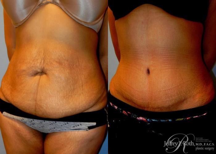 Before & After Tummy Tuck Case 35 View #2 View in Las Vegas and Henderson, NV