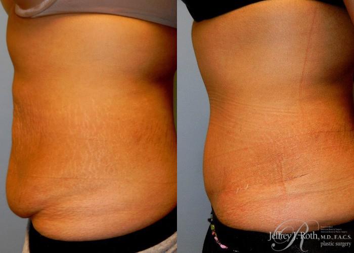 Before & After Tummy Tuck Case 35 View #3 View in Las Vegas and Henderson, NV